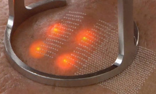 The impact of laser on the skin