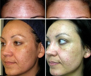 Before and after non-ablative fractional laser resurfacing