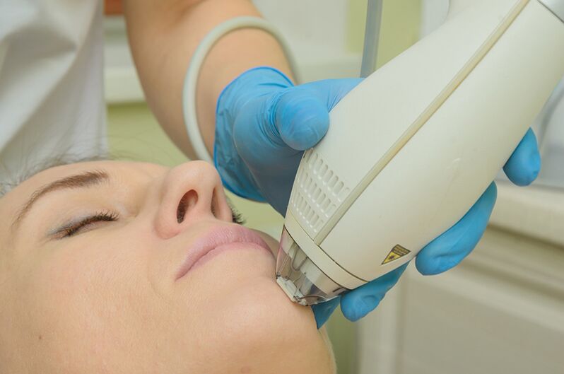 Laser rejuvenation