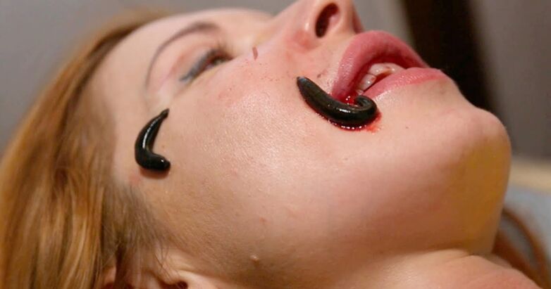 Rejuvenation with leeches