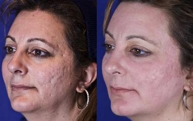 fractional laser resurfacing before and after photos