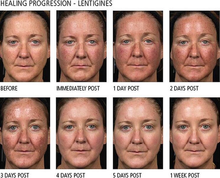 Progress after fractional laser treatment of facial skin