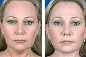 Before and after laser facial rejuvenation.